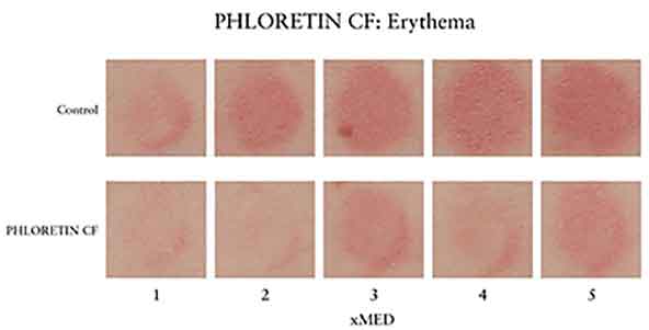 PHLORETIN-CF-ERYTHEMA