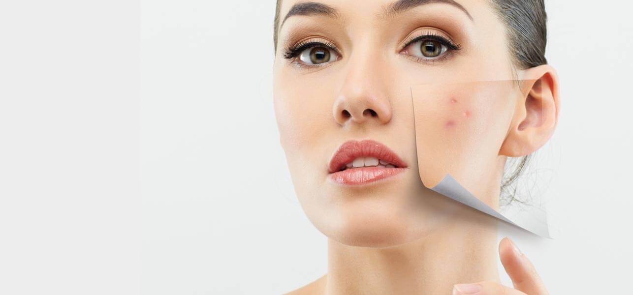 zits treatment skin Pimples,  and Solutions to Breakouts SkinMiles Acne The