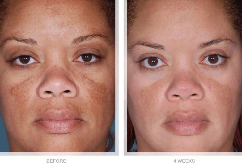OBAGI-NUDERM-CLEAR-FX-&-NUDERM-BLEND-FX-BEFORE-AND-AFTER